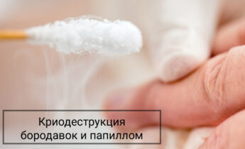Криодеструкция бородавок, папиллом, мозолей, контагиозных моллюсков в будние дни!